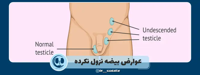 عوارض بیضه نزول نکرده