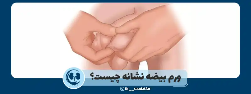 ورم بیضه نشانه چیست