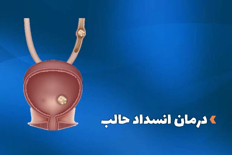 روش‌های درمان انسداد حالب