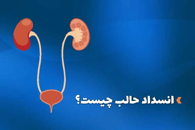 انسداد حالب چیست؟