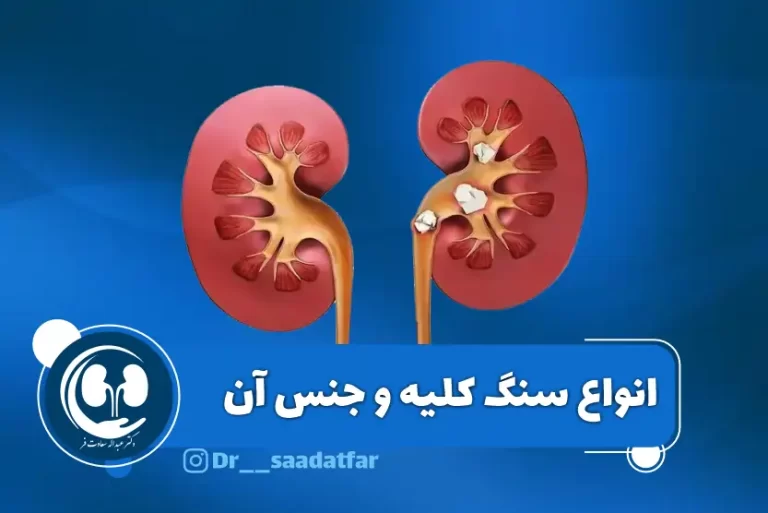 انواع سنگ کلیه و جنس آن