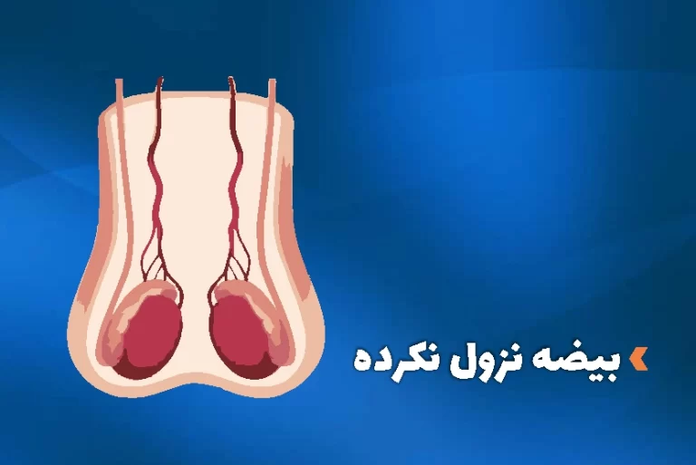 بیضه نزول نکرده