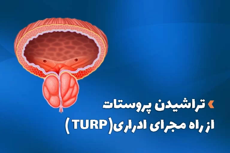 درمان بزرگی پروستات با تراشیدن پروستات از راه مجرای ادراری ( جراحی TURP)
