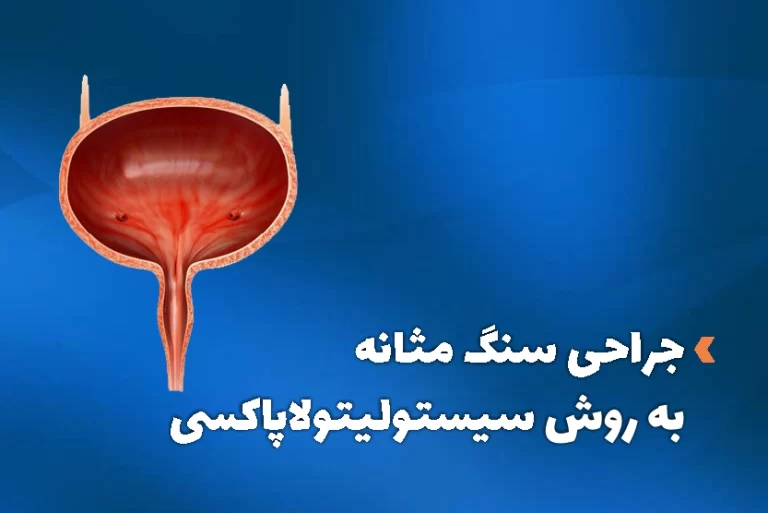 جراحی بسته سنگ مثانه به روش سیستولیتولاپاکسی چیست؟