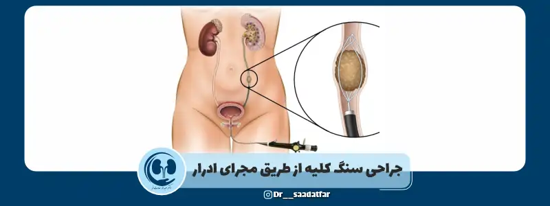 جراحی سنگ کلیه از طریق مجاری ادراری