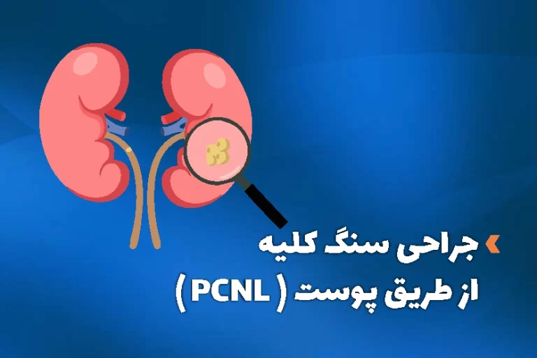 جراحی سنگ کلیه از طریق پوست (PCNL) یا همان عمل pcnl کلیه