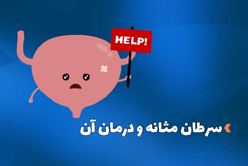سرطان مثانه و درمان آن