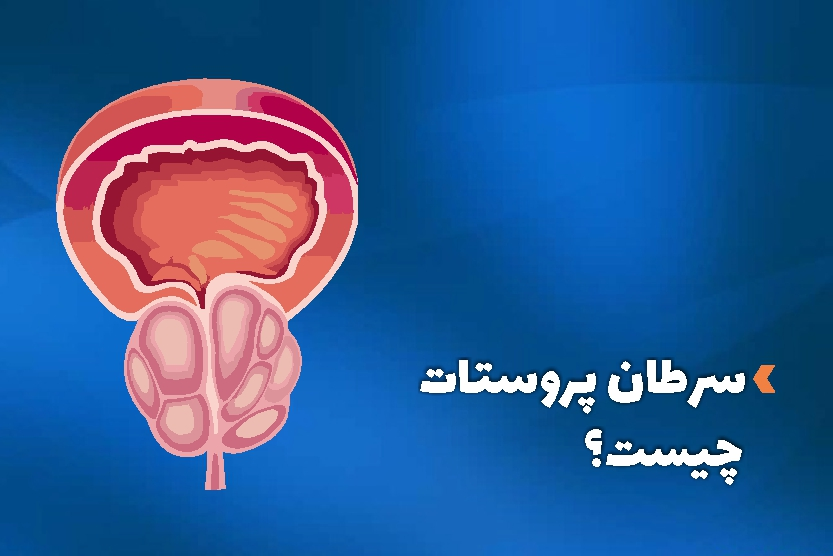 سرطان پروستات چیست؟ و روش های درمان سرطان پروستات