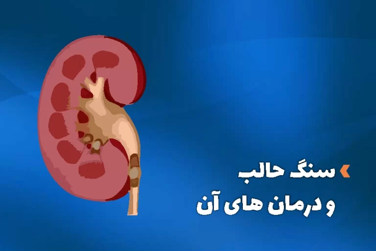 سنگ حالب چیست