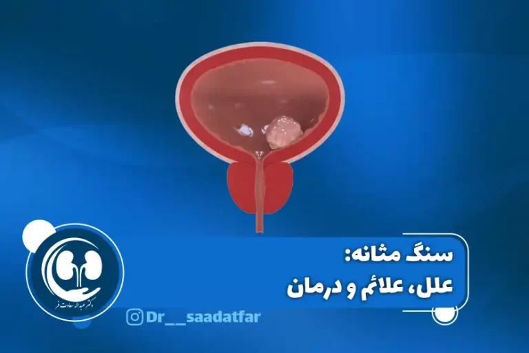 سنگ مثانه علل علائم و درمان در زنان و مردان