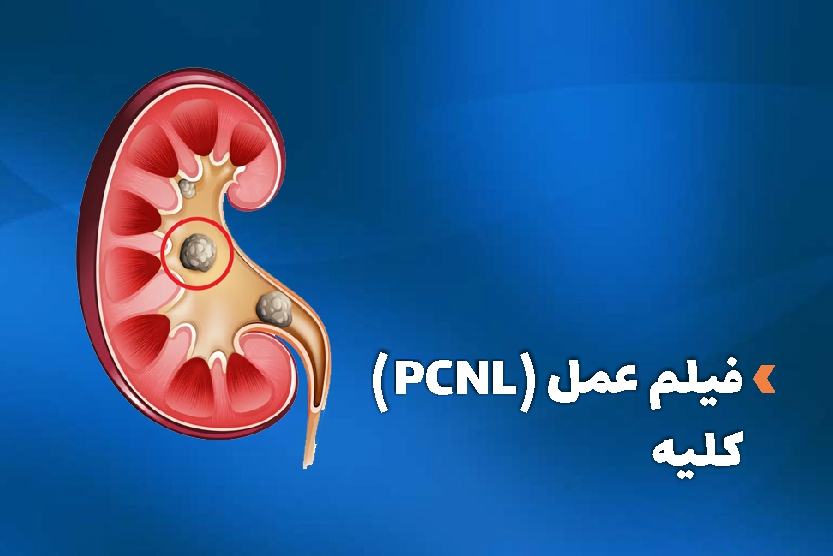 فیلم عمل PCNL کلیه