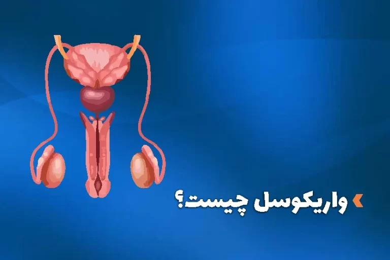 واریکوسل چیست و چه تاثیری در ناباروری مردان دارد؟