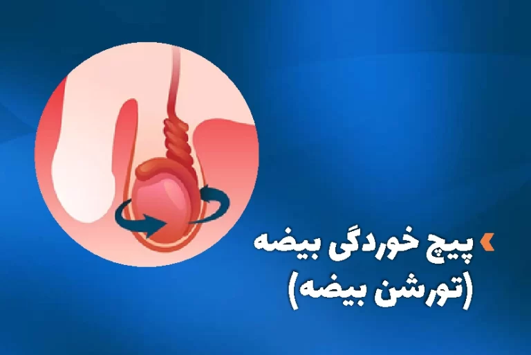 پیچ خوردگی بیضه