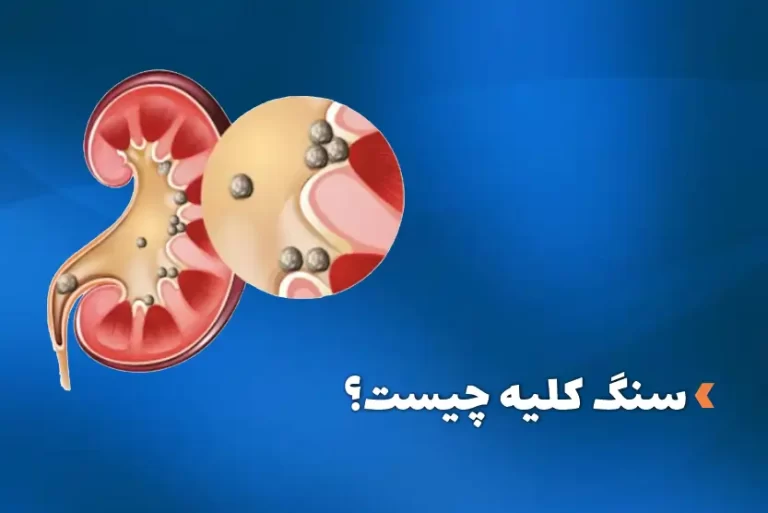 سنگ کلیه چیست؟
