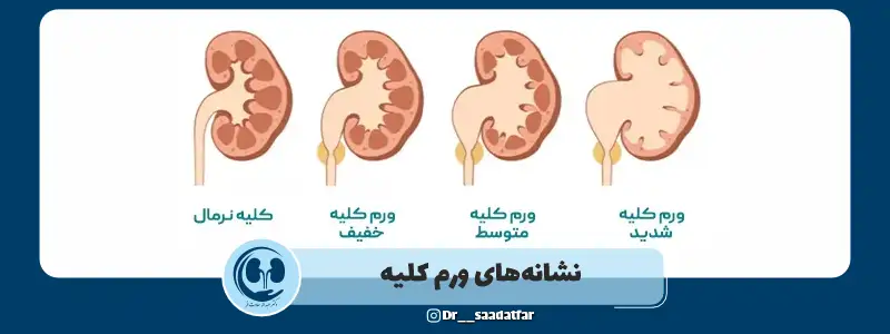 نشانه های ورم کلیه