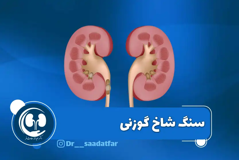 همه چیز درمورد سنگ شاخ گوزنی