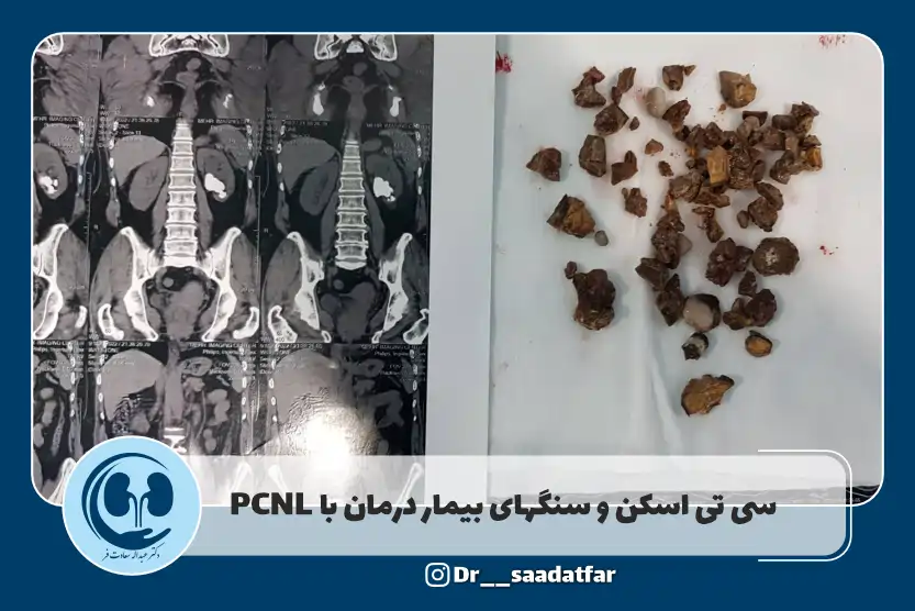 سنگ های خورد شده در عمل PCNL به همراه تصویر ct Scan
