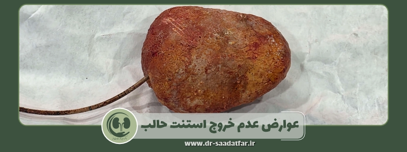 عوارض عدم خروج استنت حالب