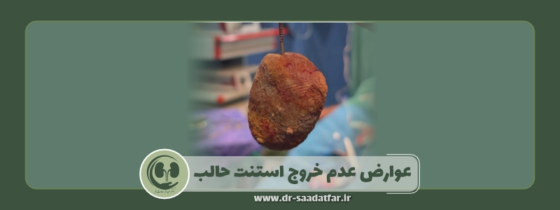 عوارض عدم خروج استنت حالب