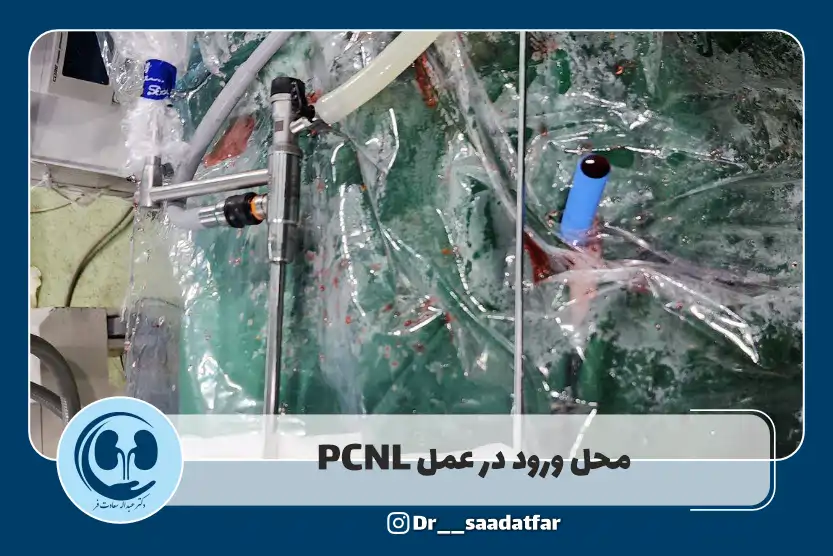 ناحیه برش در عمل pcnl کلیه