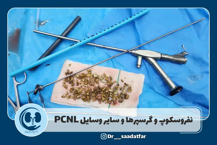 نفروسکوپ و گرسپر در عمل pcnl کلیه