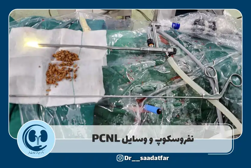 نفروسکوپ در عمل PCNL