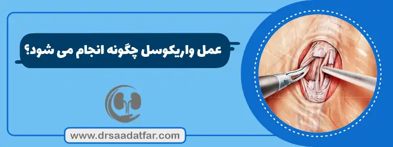 عمل واریکوسل چگونه انجام میشود؟