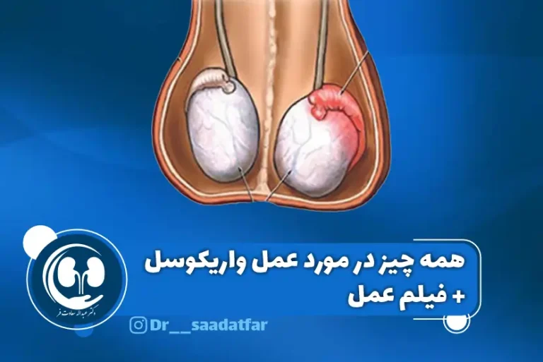 عمل واریکوسل چیست؟ به همراه فیلم جراحی واریکوسل