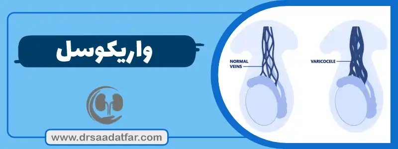 واریکوسل