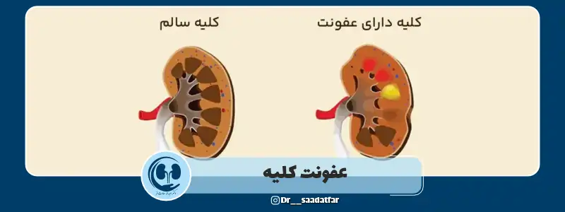 عکس عفونت کلیه