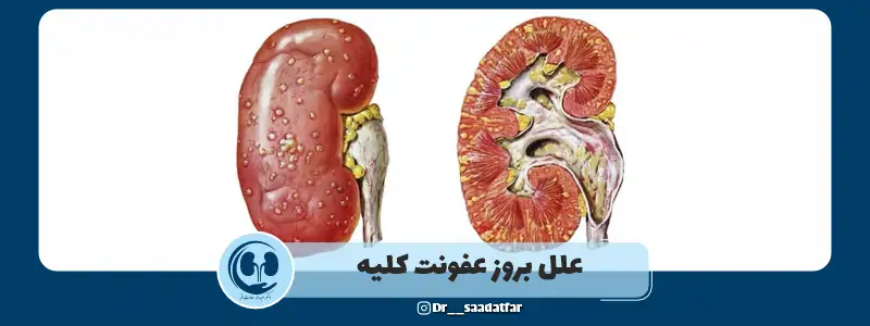علل بروز عفونت کلیه