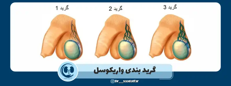 گرید بندی واریکوسل