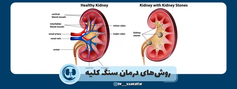روش های درمان سنگ کلیه در کرمانشاه با دکتر سعادت فر