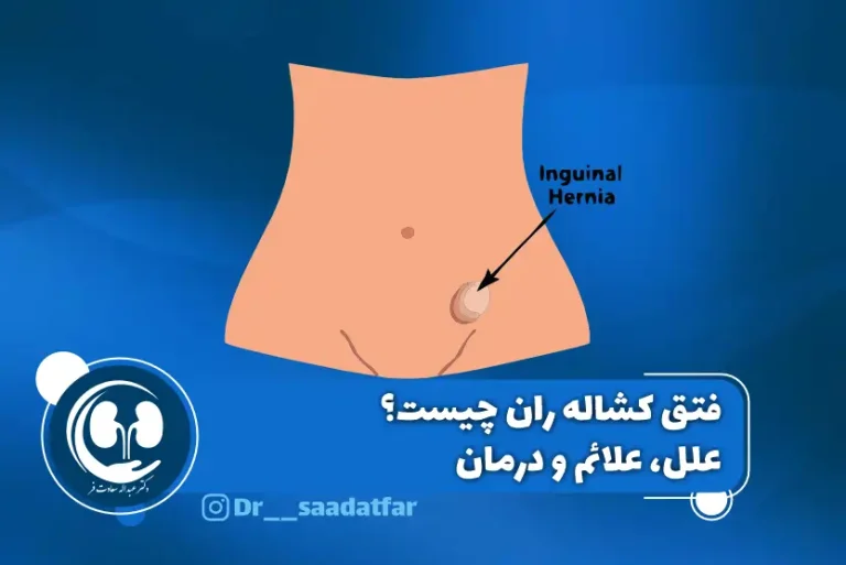 فتق کشاله ران چیست؟ علل، علائم و درمان