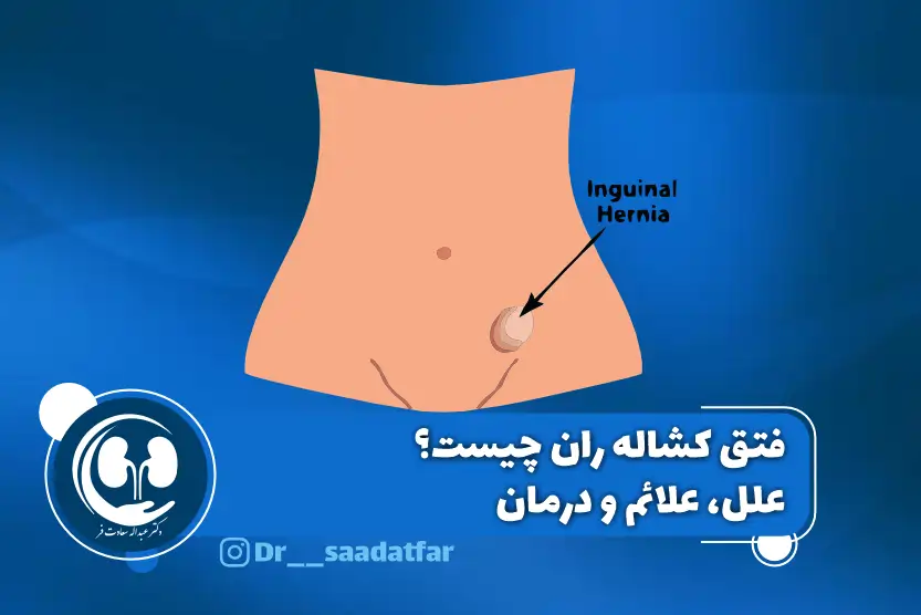 فتق کشاله ران چیست؟ علل، علائم و درمان