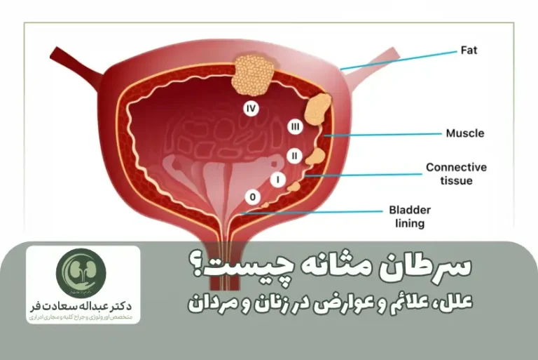 سرطان مثانه چیست؟