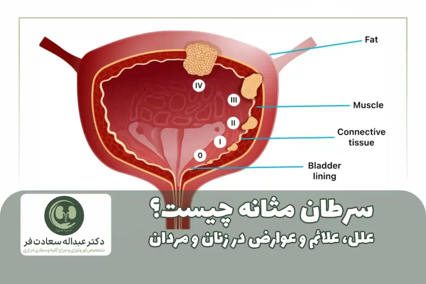 سرطان مثانه چیست؟