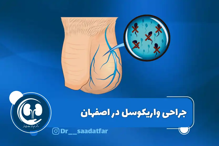 عمل واریکوسل در اصفهان