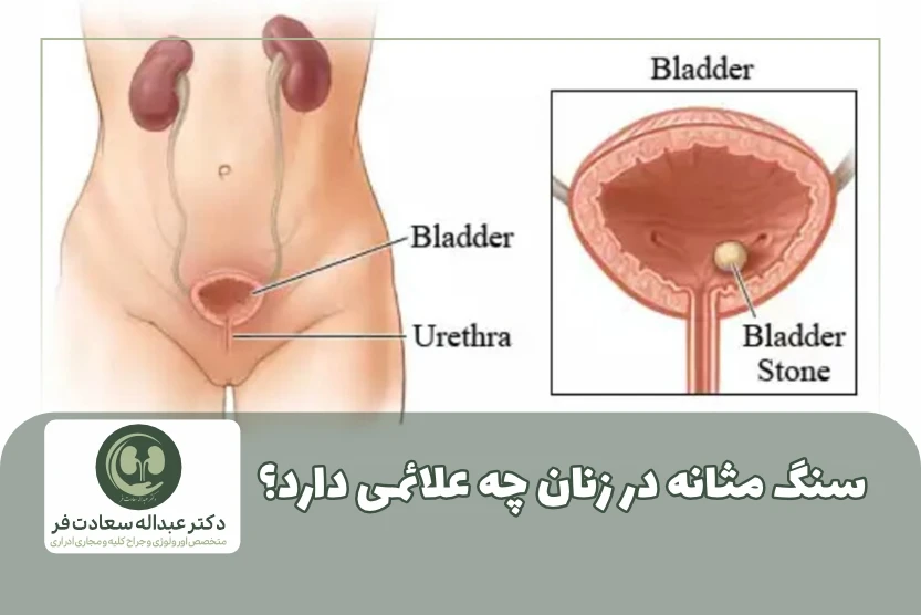 سنگ مثانه در زنان چه علائمی دارد؟