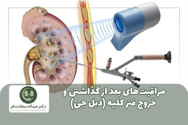 مراقبت بعد از گذاشتن فنر کلیه (دبل جی)