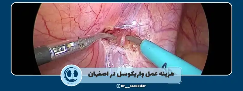 هزینه عمل واریکوسل در اصفهان
