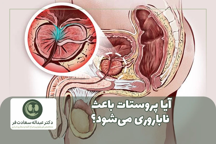 آیا پروستات باعث ناباروری می_شود؟