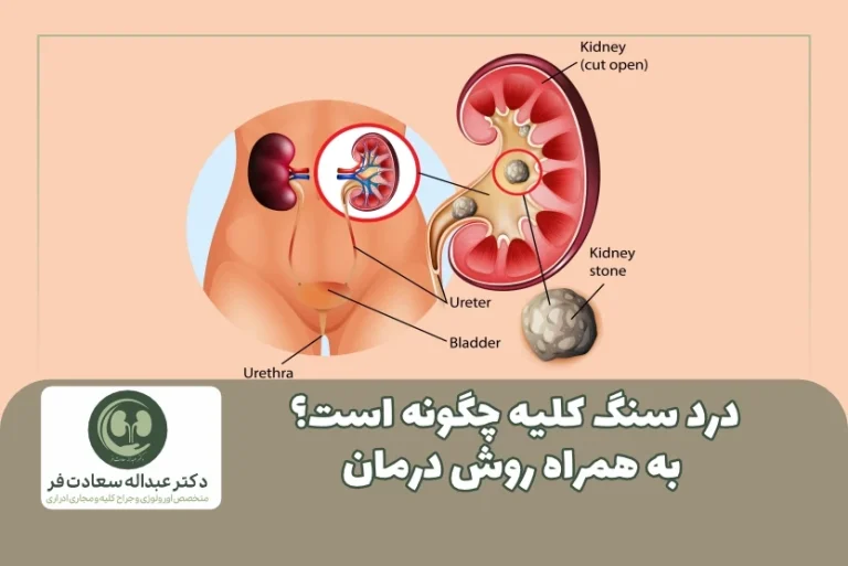 درد سنگ کلیه چگونه است؟ به همراه روش درمان