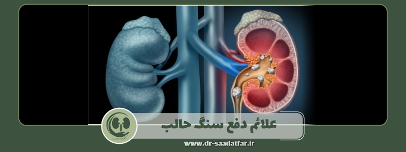 علائم دفع سنگ حالب