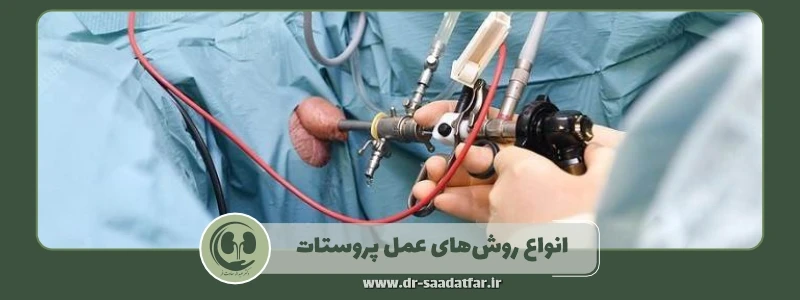 انواع روش های عمل پروستات