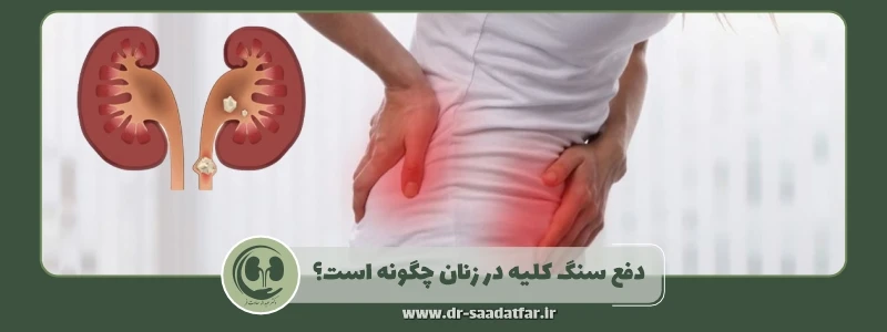 دفع سنگ کلیه در زنان چگونه است؟