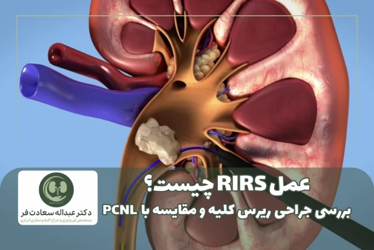 عمل ریرس چیست؟
