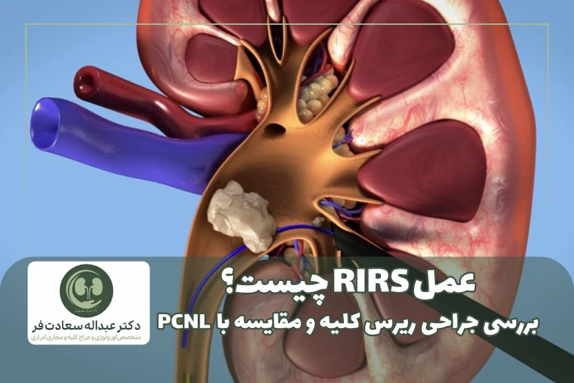 عمل ریرس چیست؟