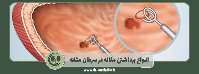 انواع برداشتن مثانه در سرطان مثانه