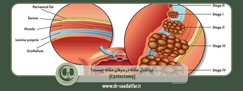 برداشتن مثانه در سرطان مثانه چیست؟ (Cystectomy)